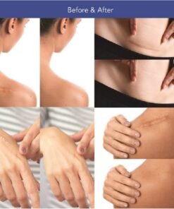 Alternative view of Silicone Effective Skin Scar Tape